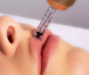 NOWY i BEZBOLESNY zabieg wypełniania ust kwasem hialuronowym - HIALURON PEN